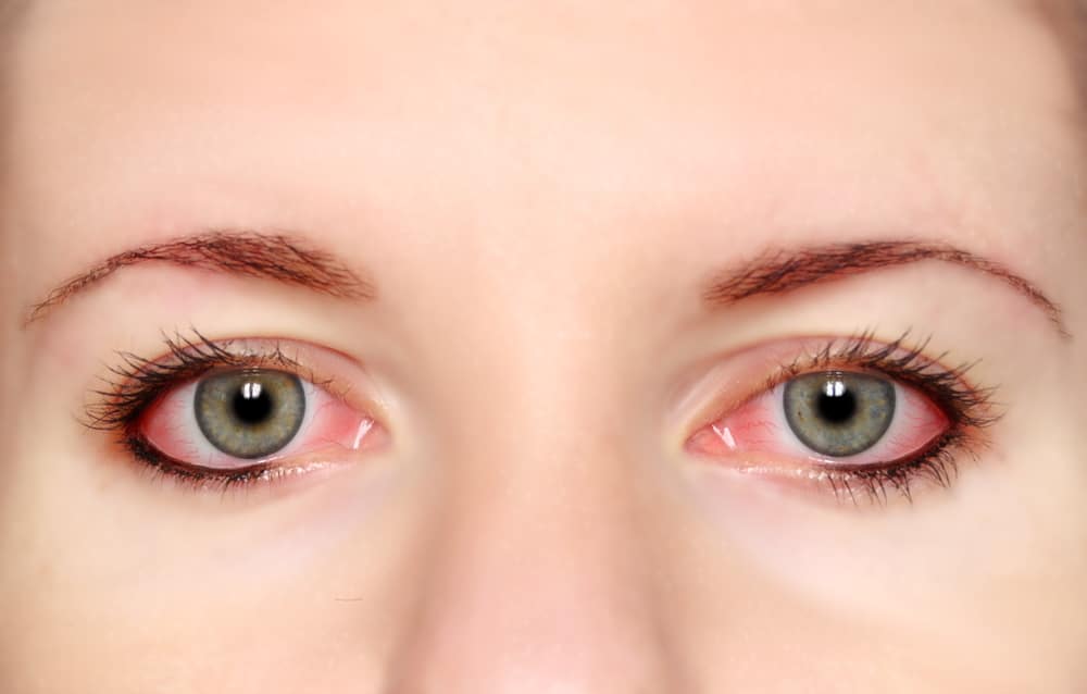 Pink Eye