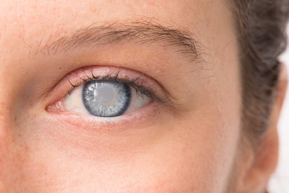 5 Signs You May Be Developing Cataracts