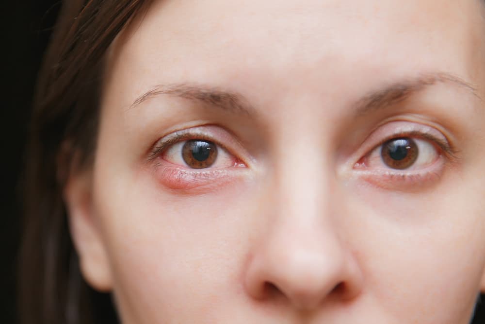 What Causes an Eye Stye?