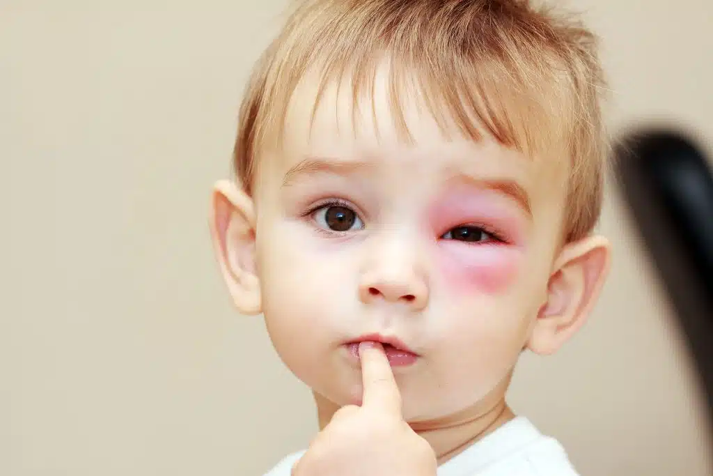 Tips on How to Prevent Eye Injuries in Children