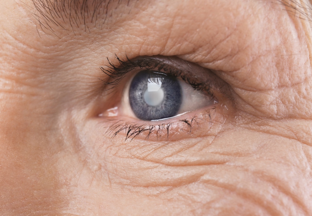What to Expect After Cataract Surgery