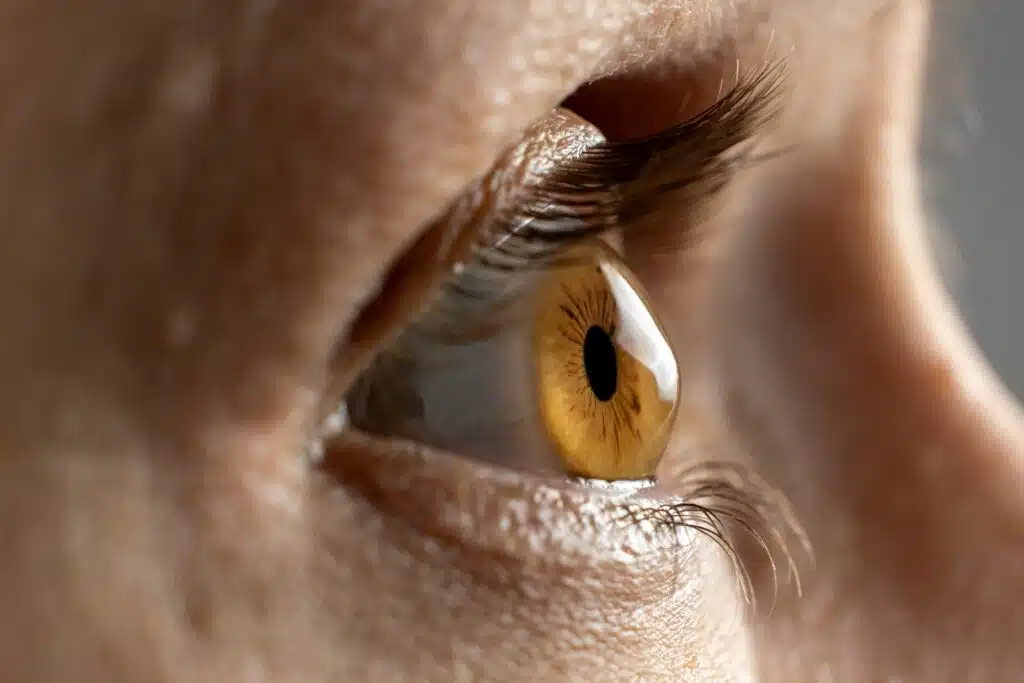 Eye exhibiting signs of keratoconus